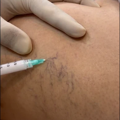 اسکلروتراپی